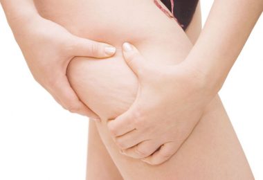 Mujer joven con celulitis en la zona de las piernas