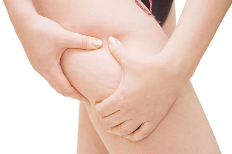Mujer joven con celulitis en la zona de las piernas