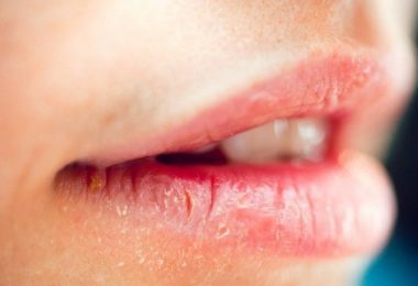 Una chica con los labios secos