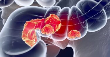 Cáncer de colon y sus sintomas