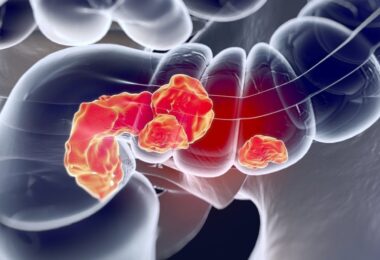 Cáncer de colon y sus sintomas