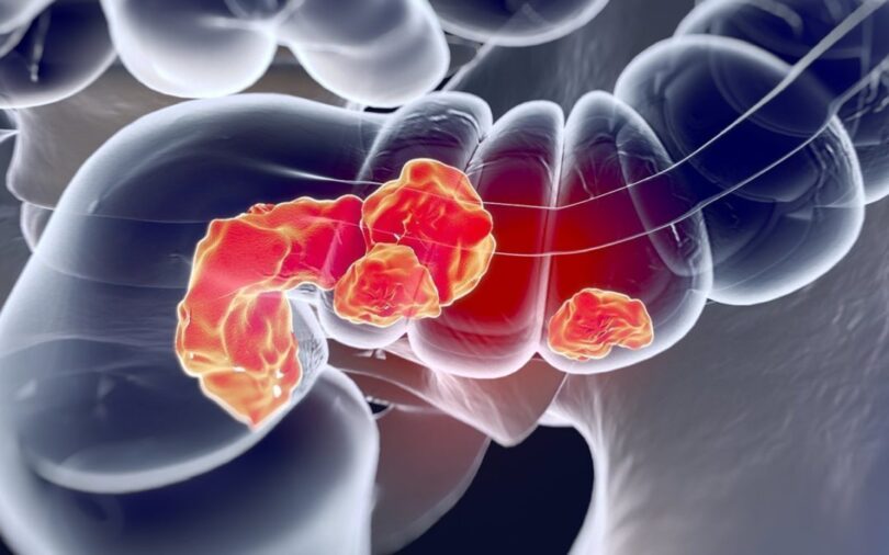 Cáncer de colon y sus sintomas
